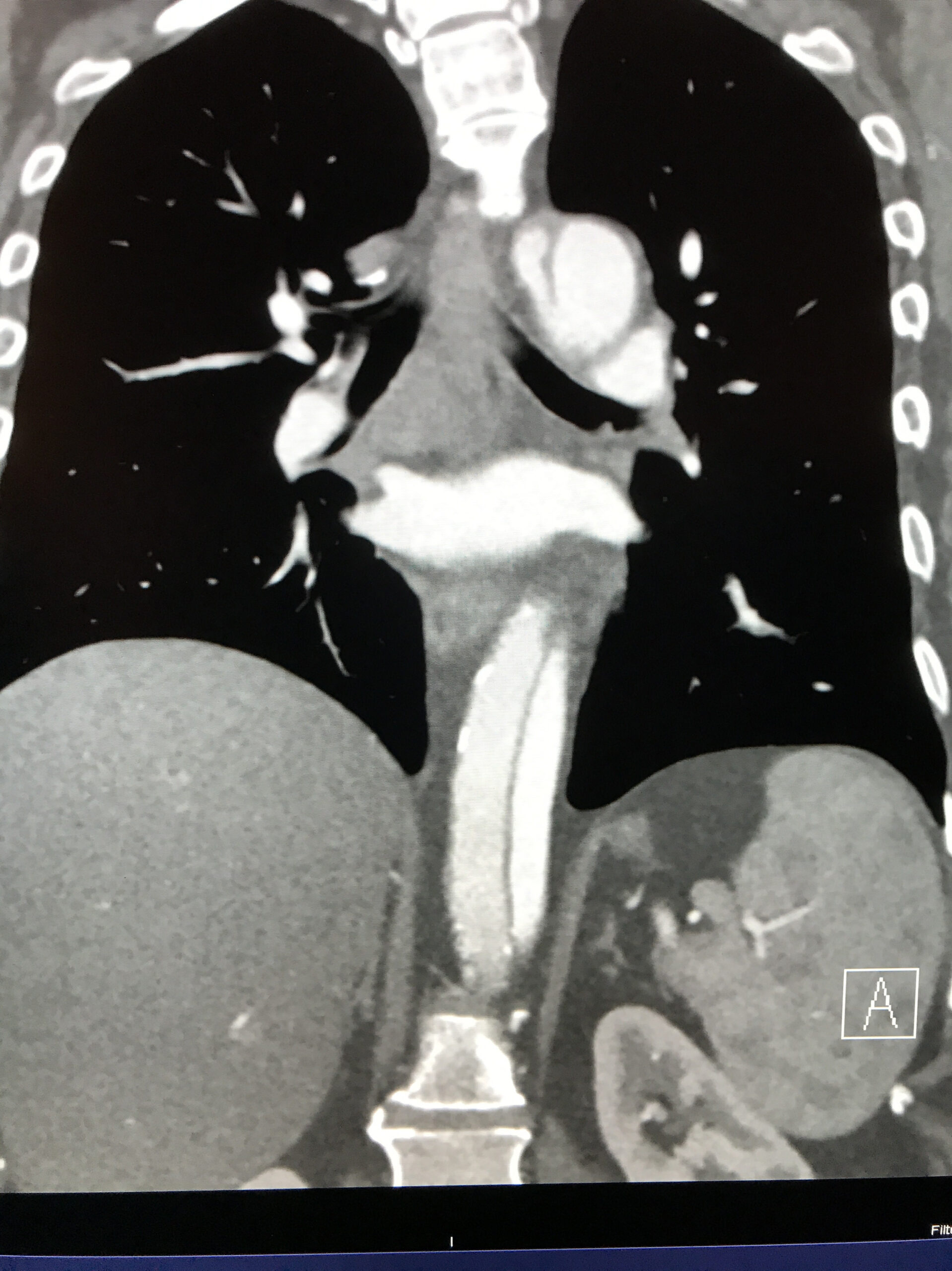 Bilateral Flank Pain in an Older Adult